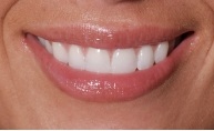 Dental Crowns In Azusa, CA And Rowland Heights, CA